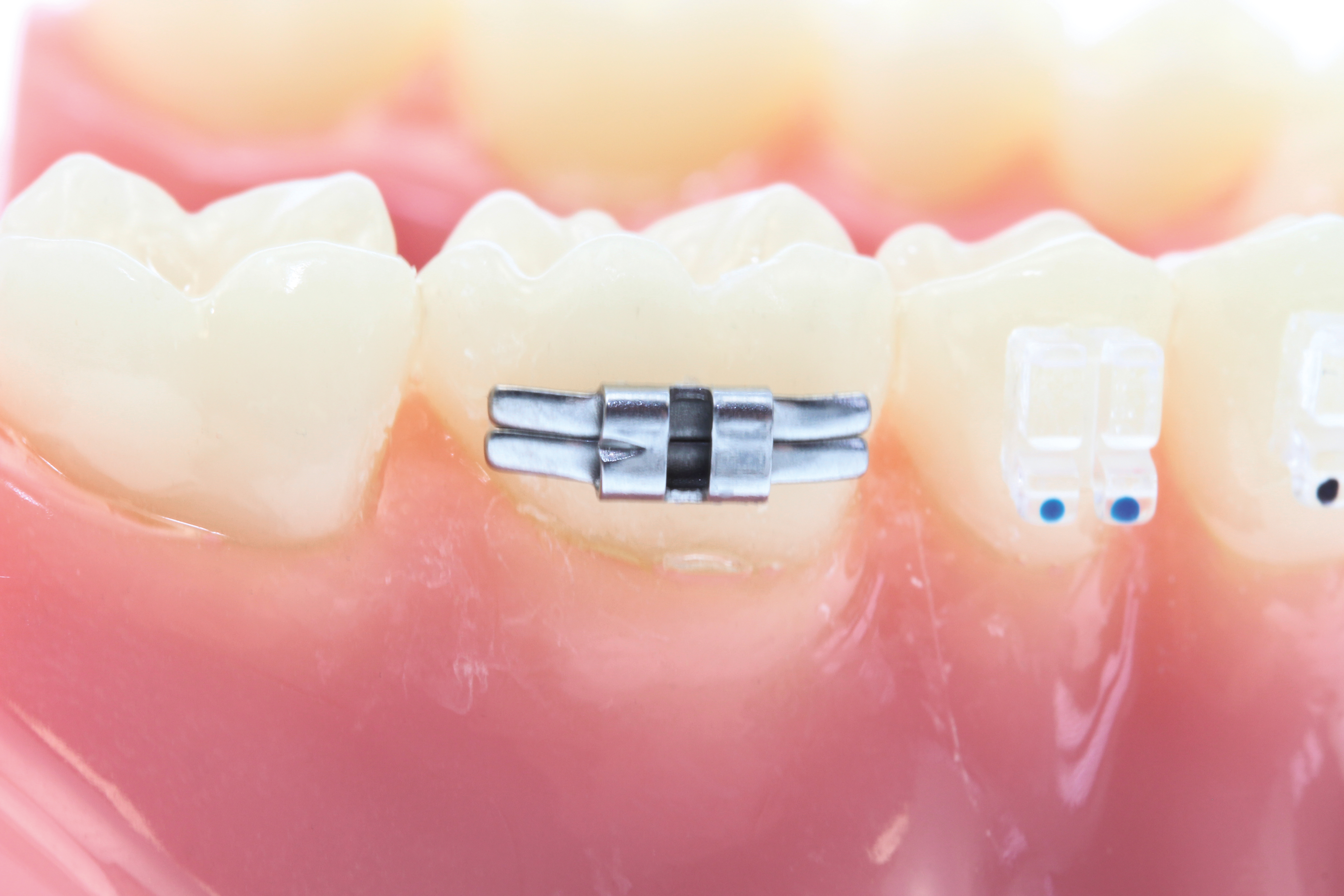 Lingual Schloß,offen,gerade, mit Stoppkerbe