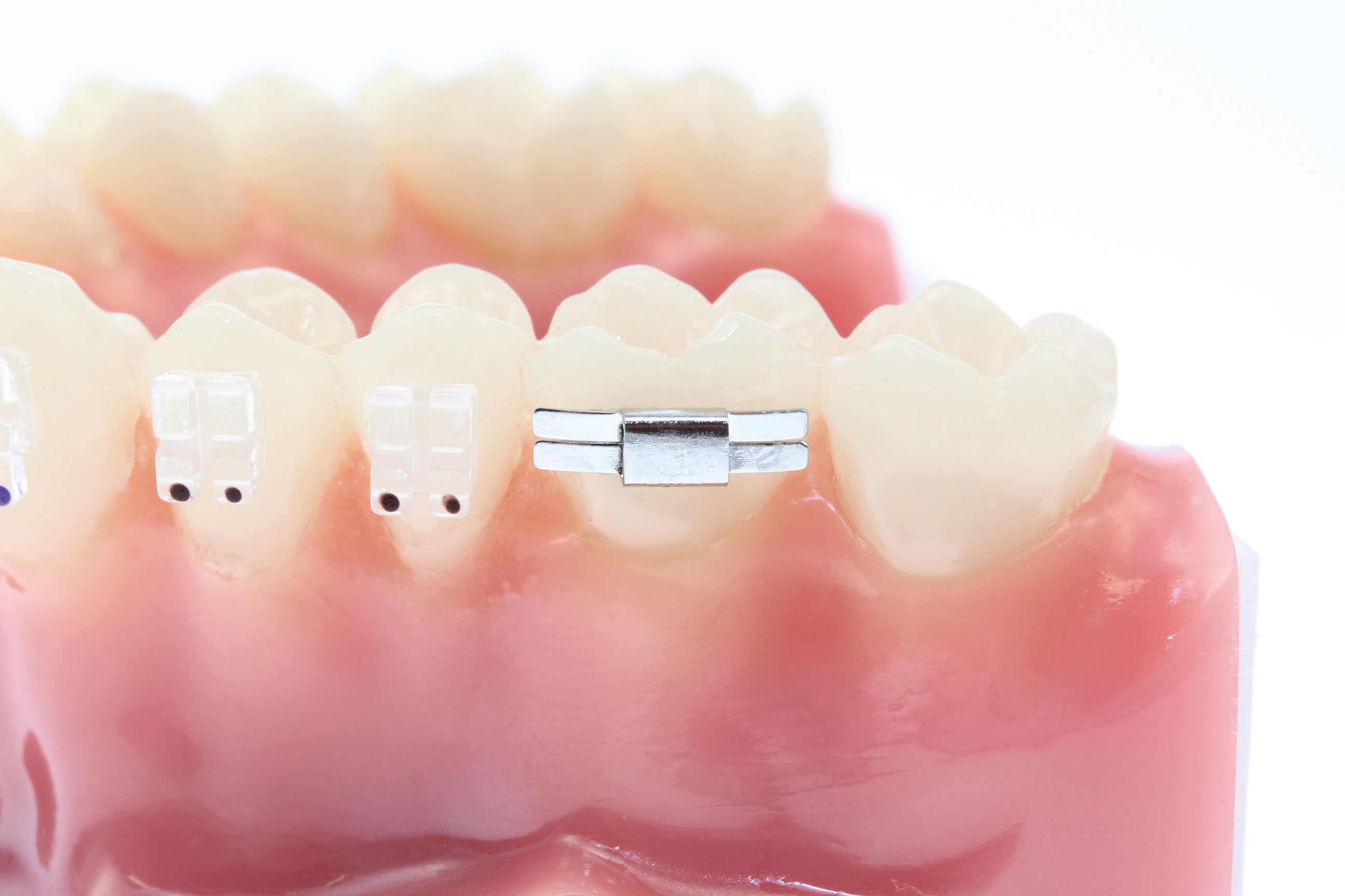 Lingual-Schloß,geschlossen,gerade ohne Stoppkerbe