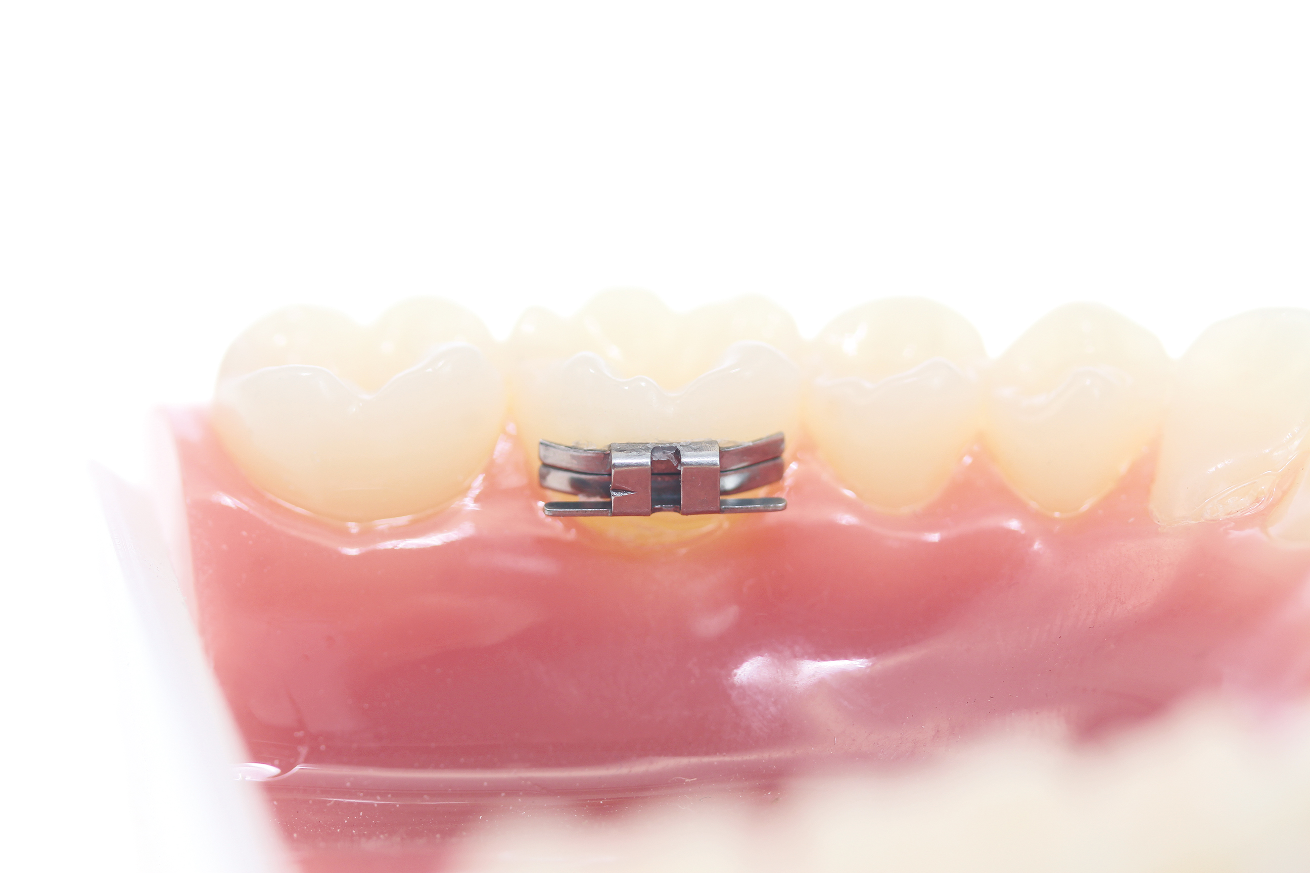 Lingual Schloß .036"